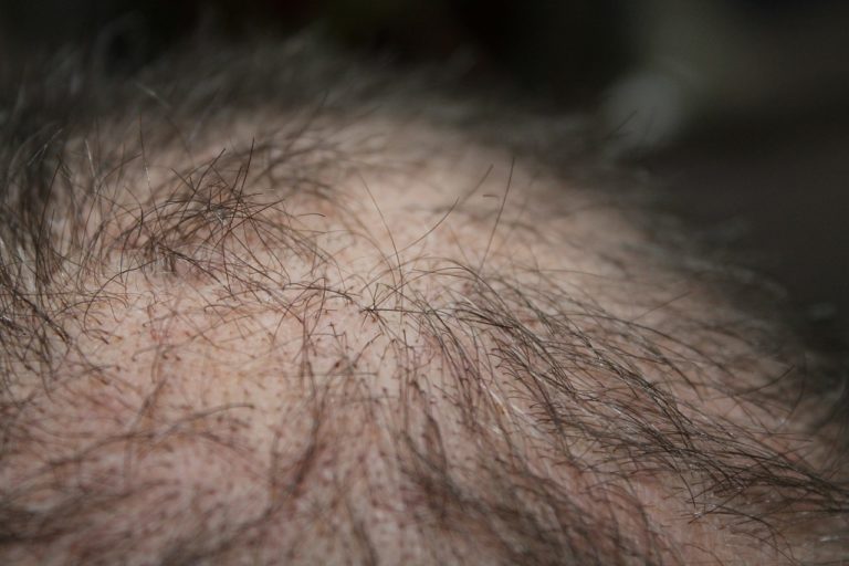 6 Common Causes of Hair Loss